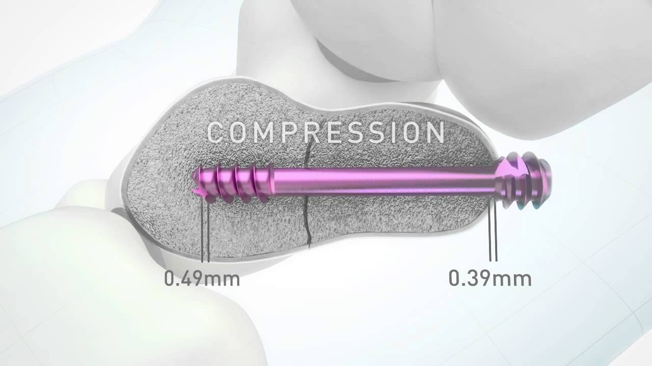 HBS 2  Headless bone screw by KLS Martin