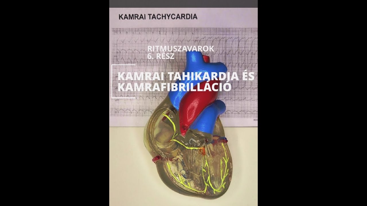 Ritmuszavarok 6.rész – Kamrai tahikardia és Kamrafibrilláció