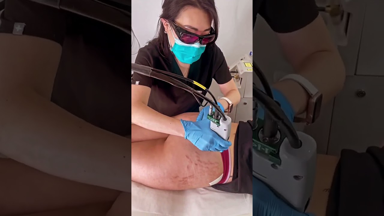 Pulsed Dye Laser minimizes the appearance of redness in red stretch marks