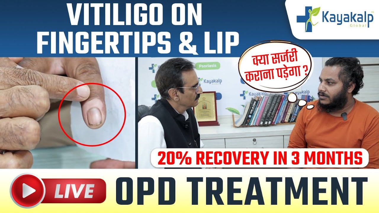 Vitiligo on Lips & Fingertips | Safed Daag Recovery in 3 Months| Cream for vitiligo| Kayakalp Global