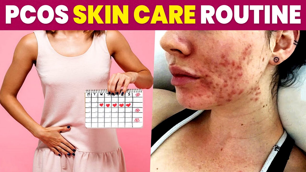 PCOS Skin Problems | PCOS Skin Care Routine in Tamil