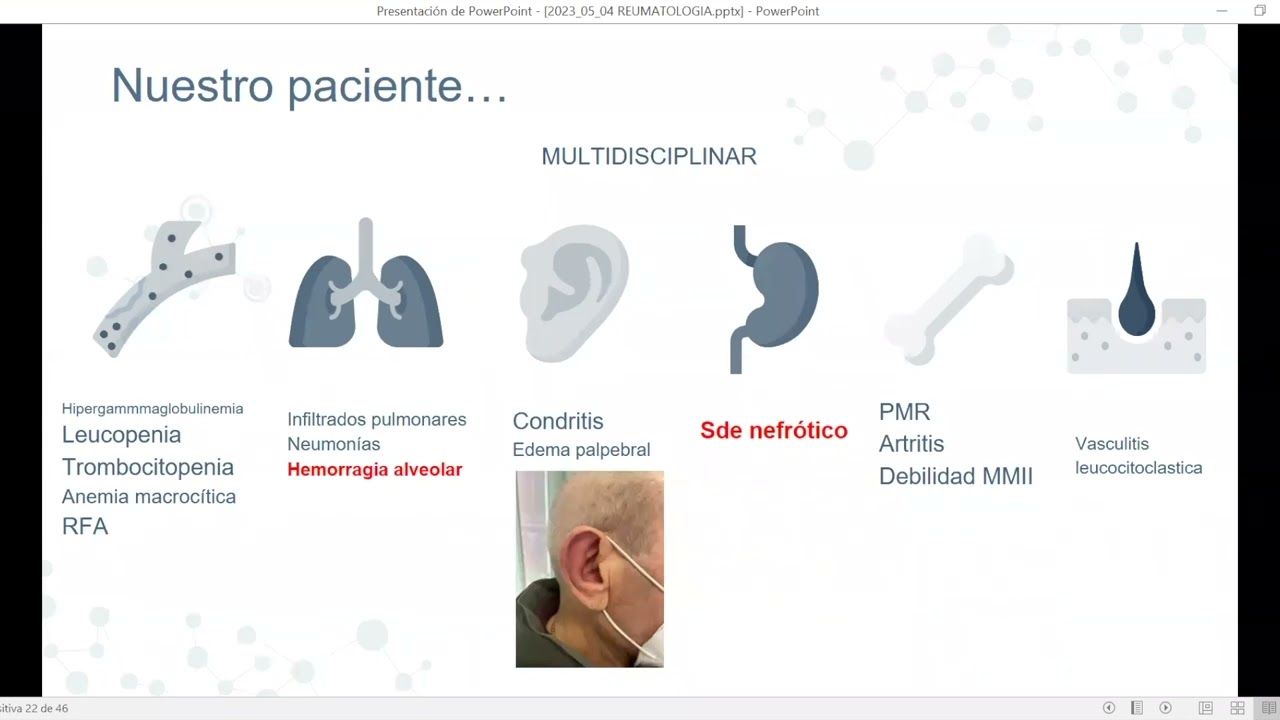 Síndrome VEXAS, una entidad emergente