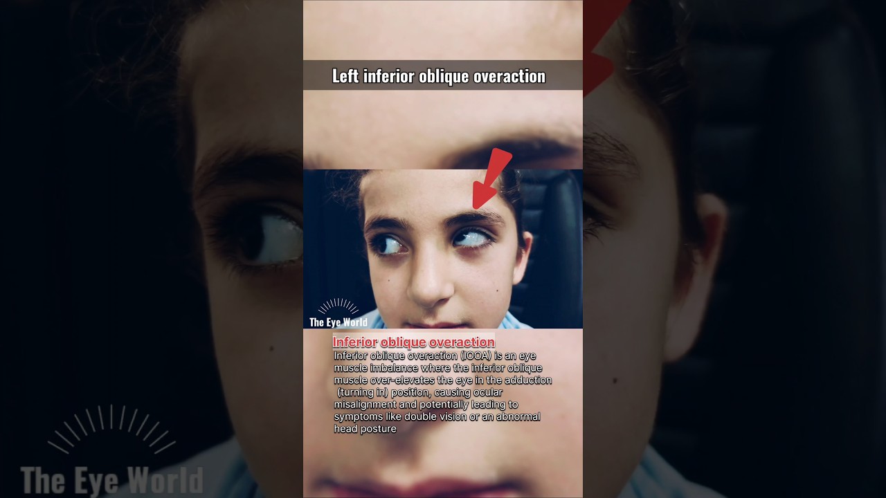 The Eye World&trade;:Left inferior oblique overaction #eyes #ophthalmology #strabismus #youtubeshorts