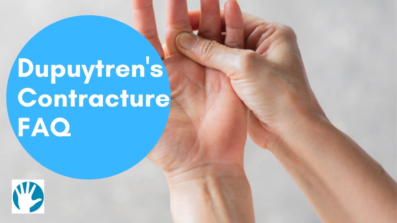 Dupuytren's Contracture FAQ - Midland Hand Clinic