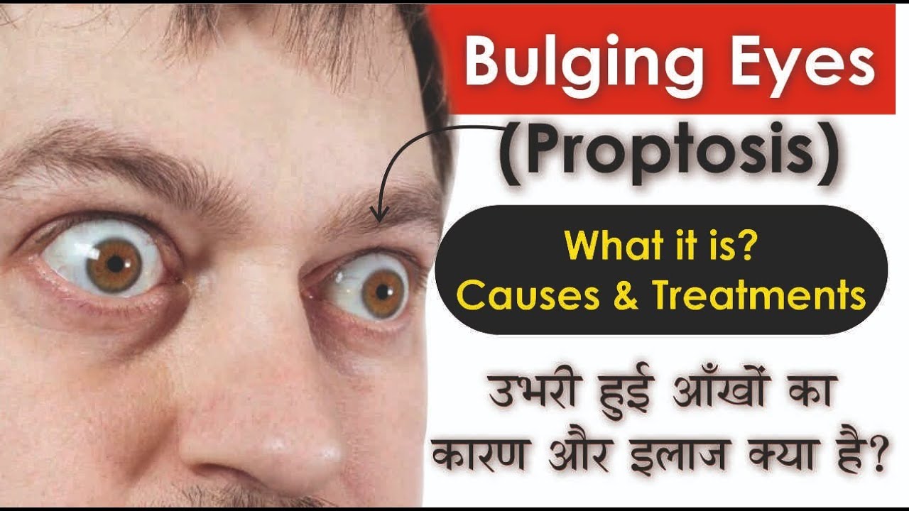 What is Bulging Eyes (Proptosis): Causes & Treatments | उभरी हुई आंखों का असल कारण क्या है?