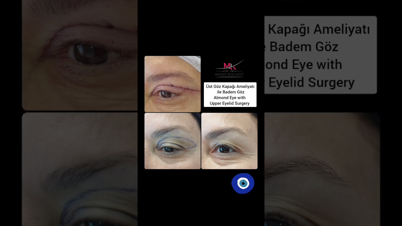 ALMOND EYES WITH UPPER EYELİD SURGERY &Uuml;ST G&Ouml;Z KAPAĞI AMELİYATI İLE BADEM G&Ouml;Z