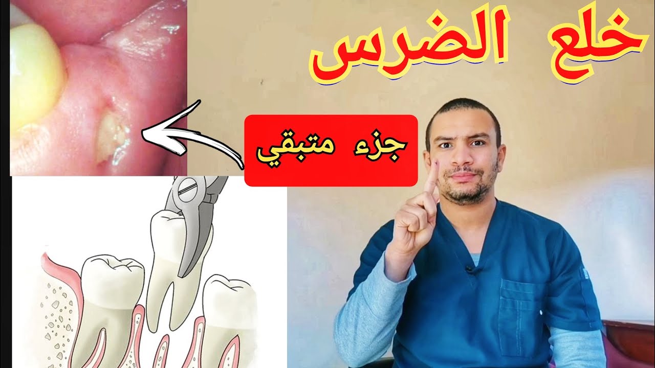 كيف تتاكد ان ضرسك تم خلعه بالكامل و لا يوجد جزء داخل الفك