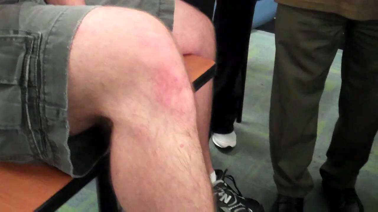 McMaster Medical Acupuncture Program: Acupuncture Point ST 36