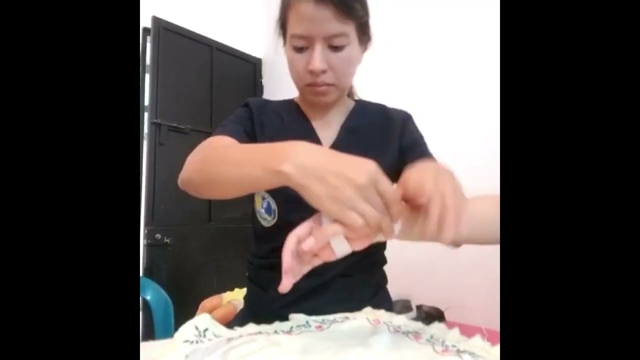 Elaboración de férula para corregir ráfaga cubital en AR.