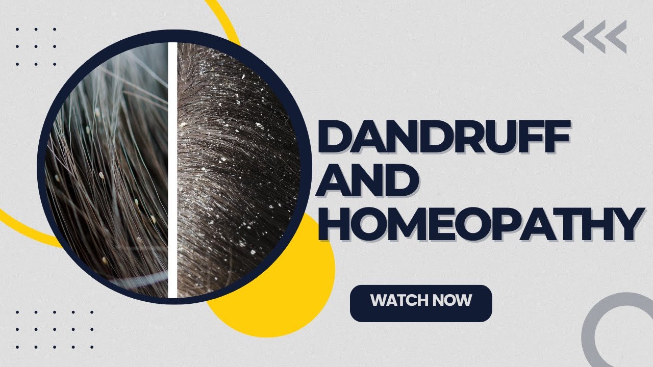 DANDRUFF || BEST HOMEOPATHIC MEDICINE FOR DANDRUFF !