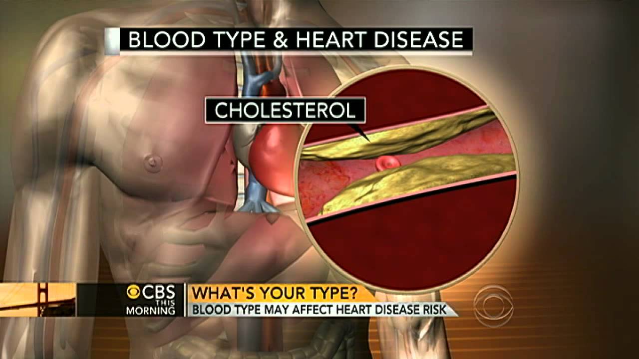 Blood type may be linked to heart disease risk: study