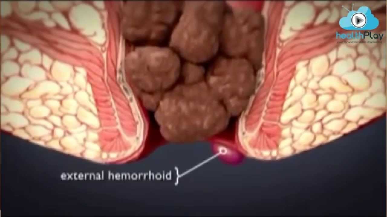 Hemoroid (Basur) &Ccedil;eşitleri Nelerdir? Op.Dr.Kadir Uskuay