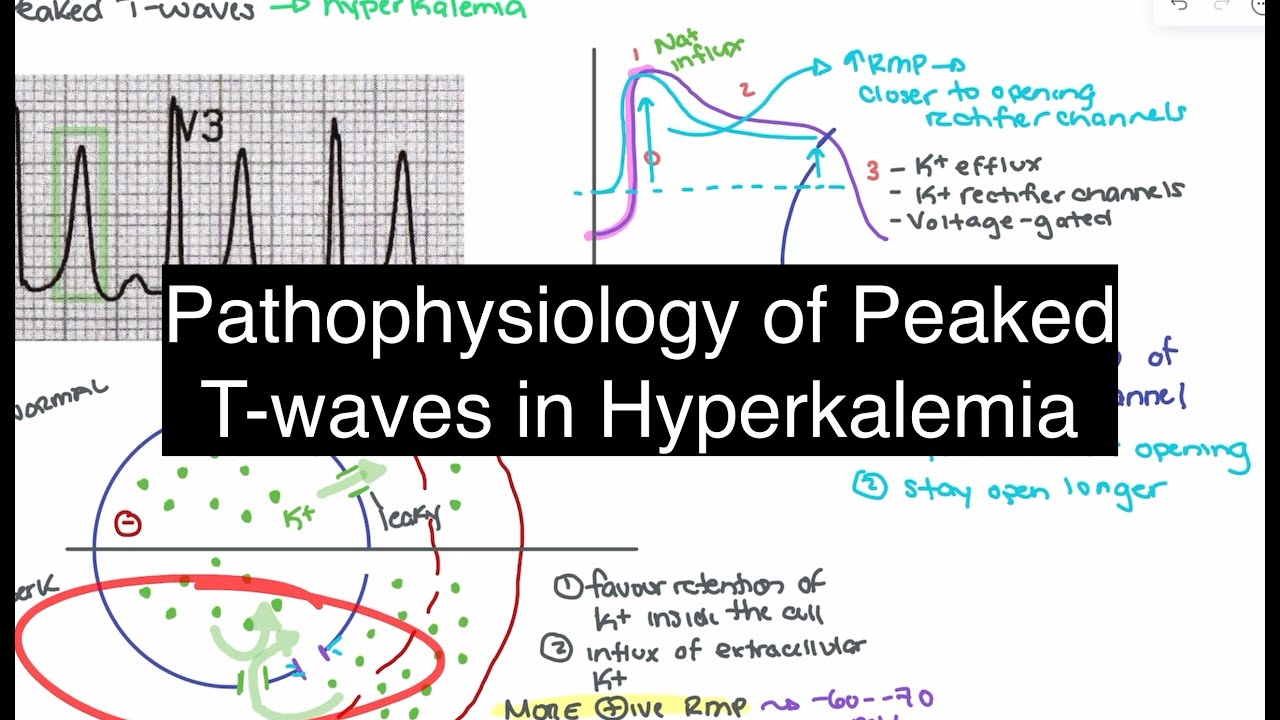 Hyperkalemia Explained: Pathophysiology of Peaked T-Waves
