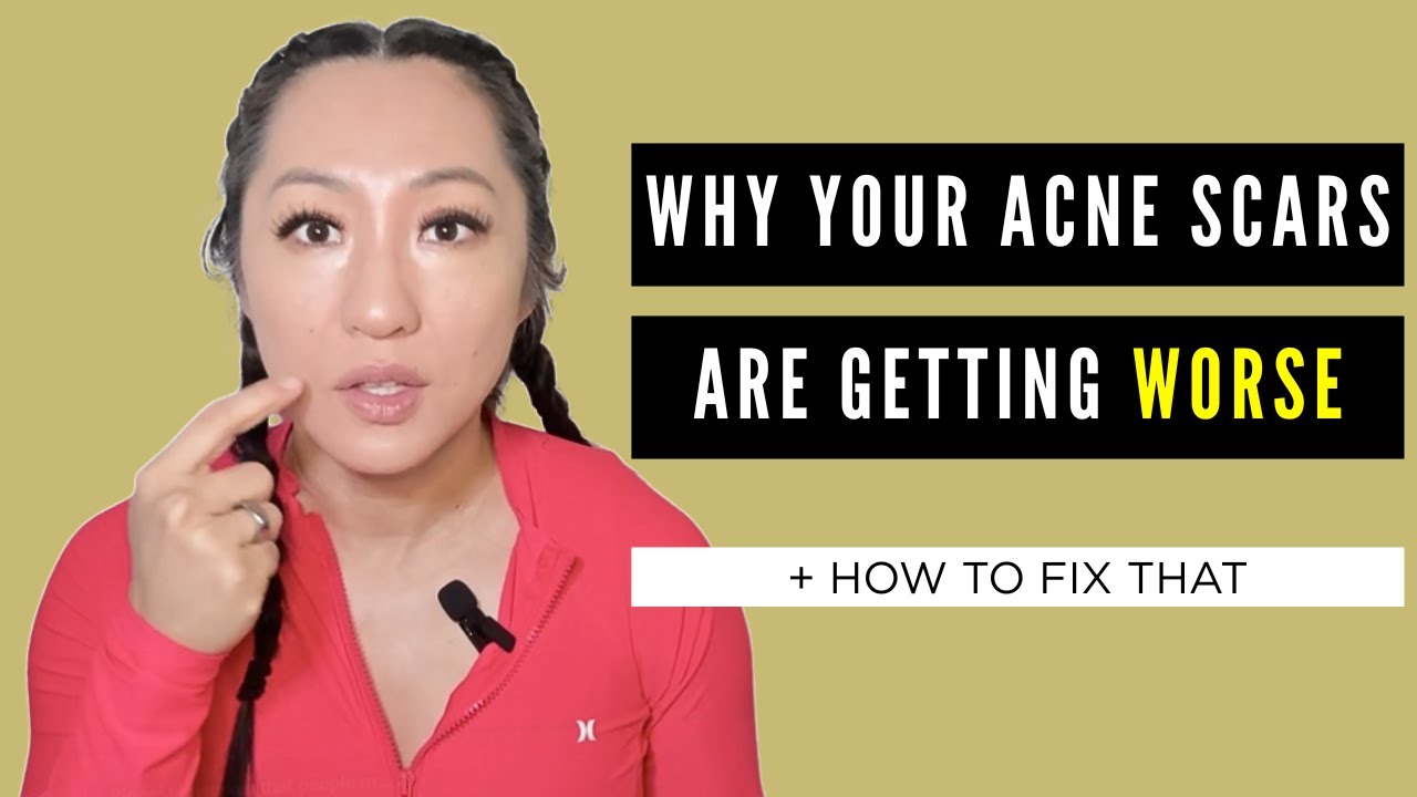 Why Your Acne Scars Are Getting Worse & Not Better + TIPS!