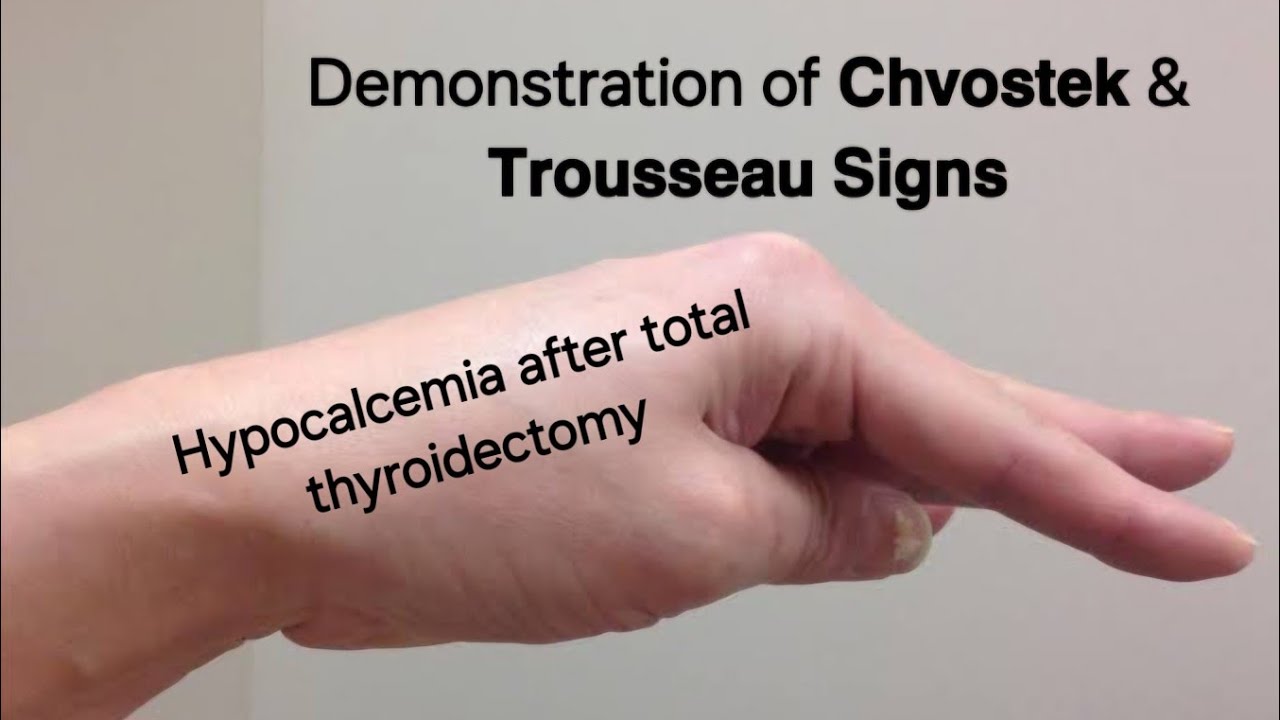 𝗖𝗵𝘃𝗼𝘀𝘁𝗲𝗸 & 𝗧𝗿𝗼𝘂𝘀𝘀𝗲𝗮𝘂 𝗦𝗶𝗴𝗻𝘀 | Total thyroidectomy | Hypocalcemia @Tayyabriazch