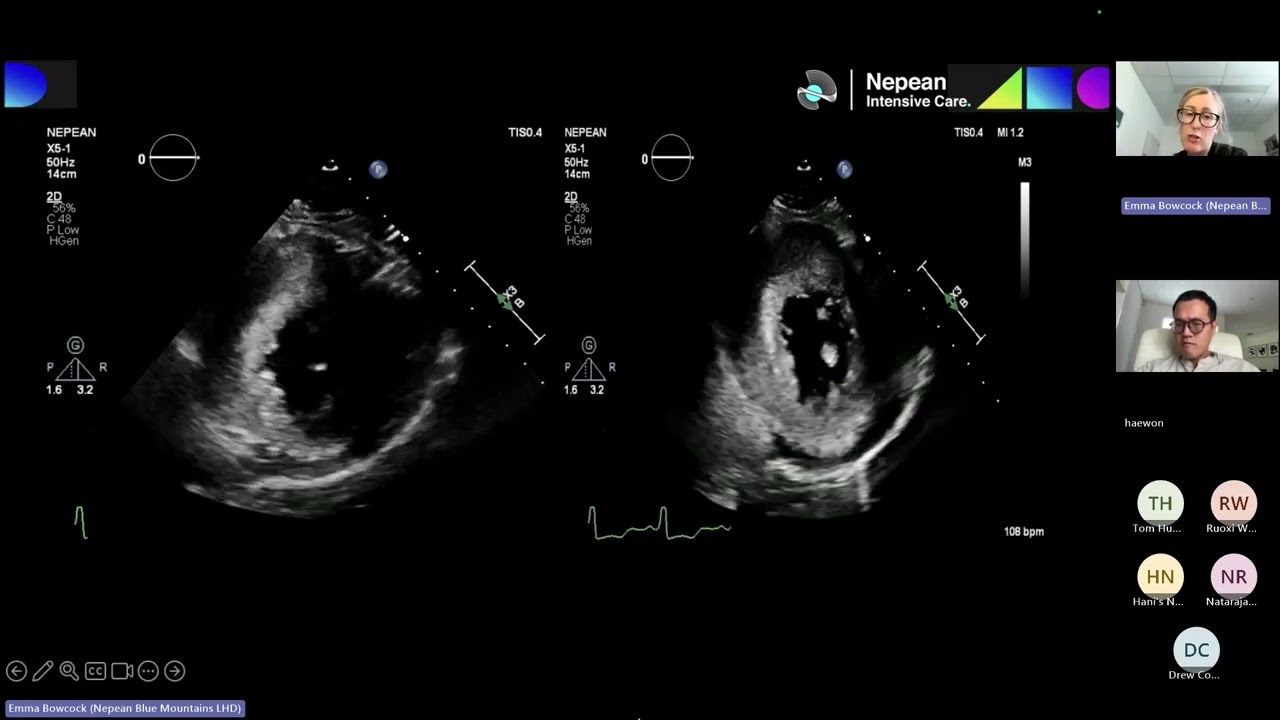 Left Ventricular Dynamic Obstruction
