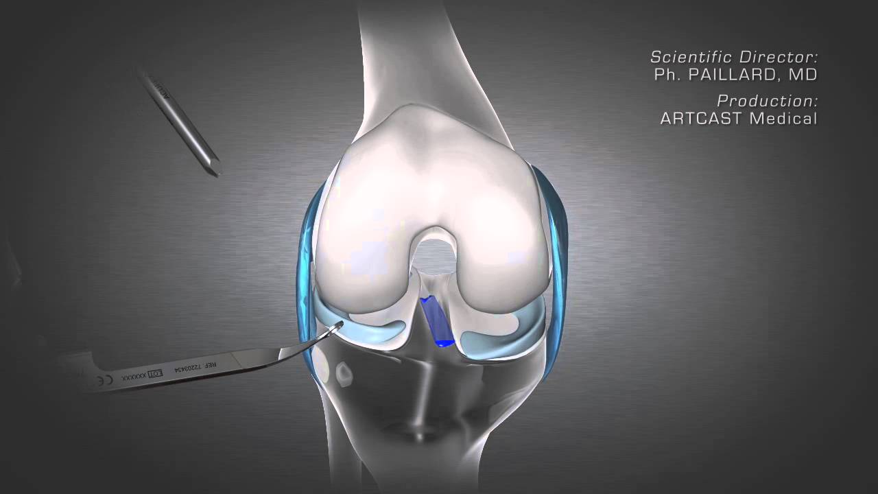 Knee Ligament Reconstruction