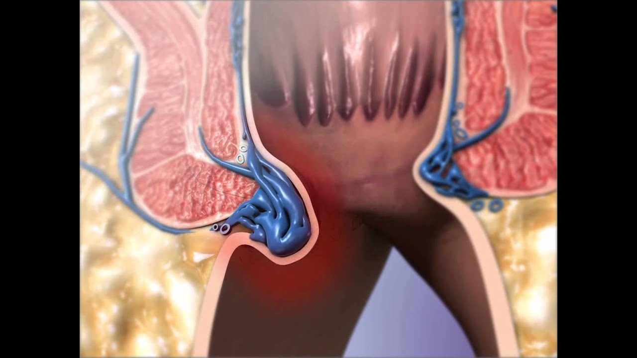Геморрой: Learn@Visible Body