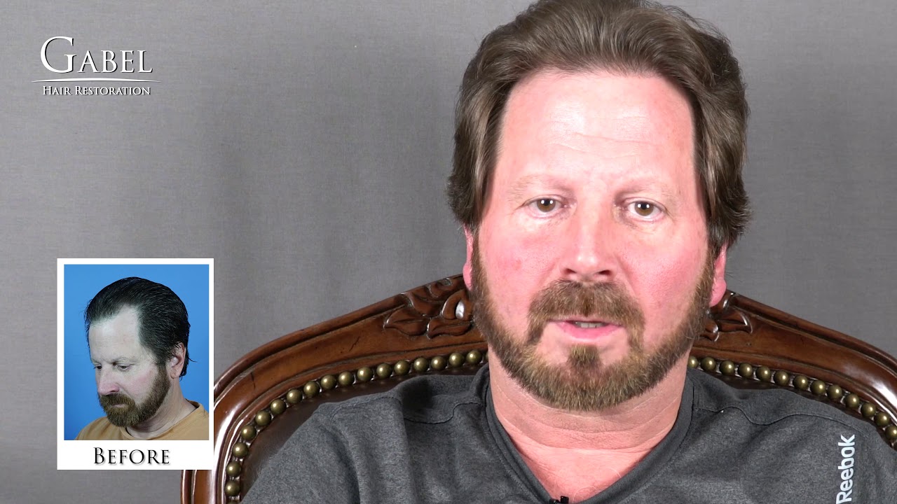 Before and after results hair transplant of 1600 grafts in 53 yr old man by Dr Steven Gabel
