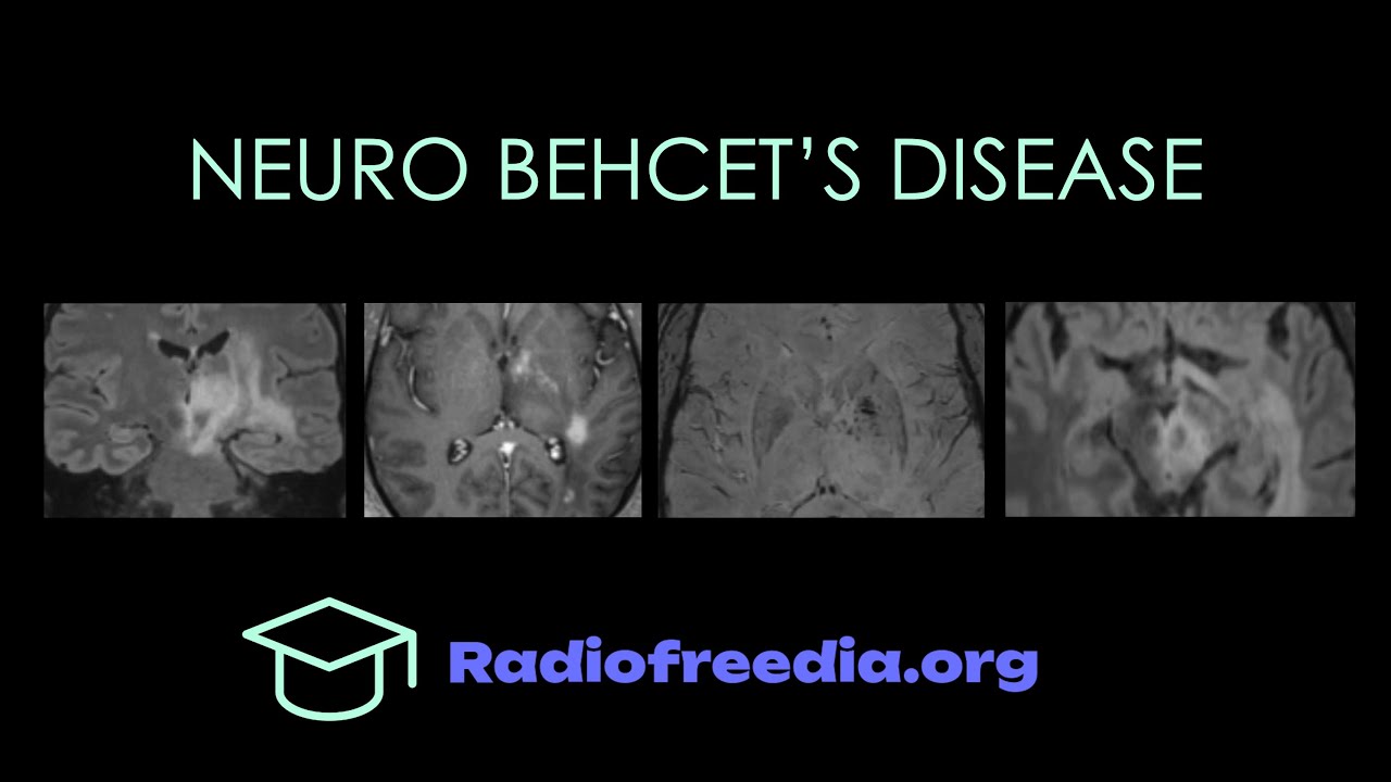 Neuro Behcet's Disease Imaging Walkthrough | Radiofreedia.org