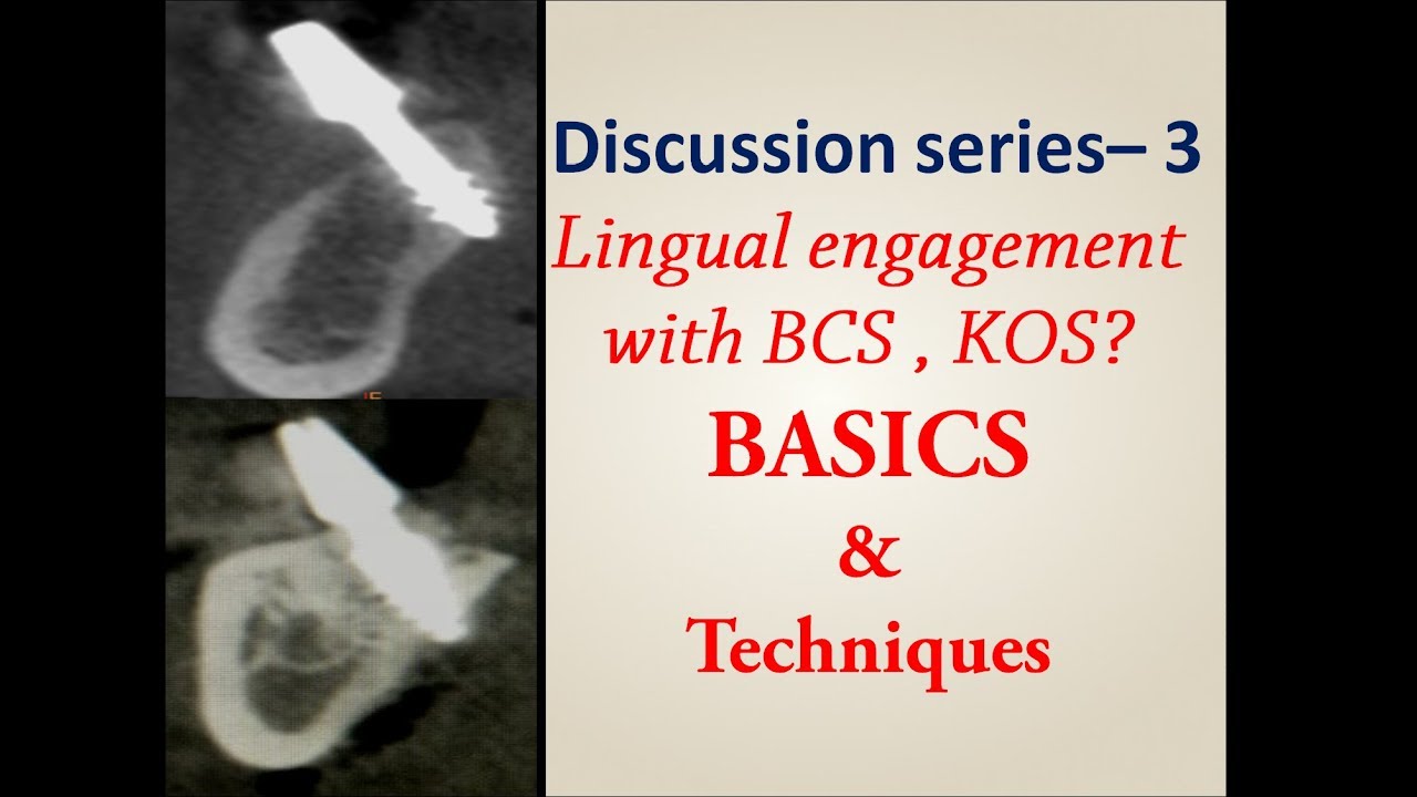 Resorbed distal mandible - Planning for basal implants - Lecture by Dr.C.Murugavel
