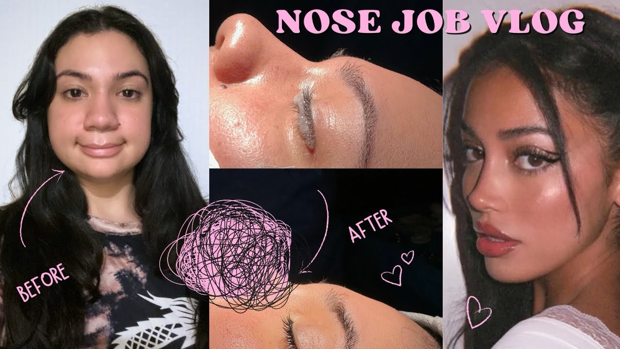 Nose Job Vlog: My Wild Ethnic Rhinoplasty Experience in Turkey