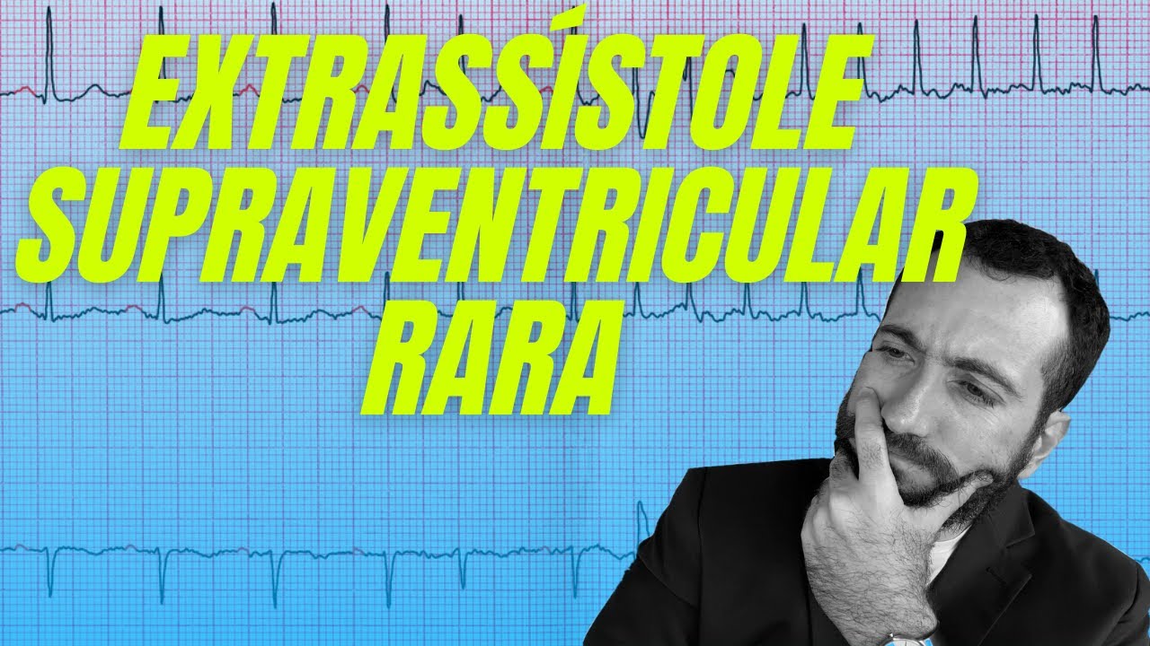 Extrassístole supraventricular rara