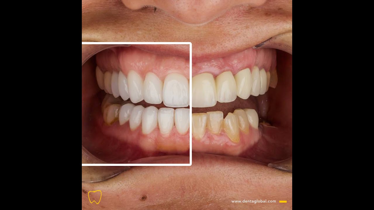 B/A Series #71 Natural and glossy as always! Check out this natural new design! 🦷🤩