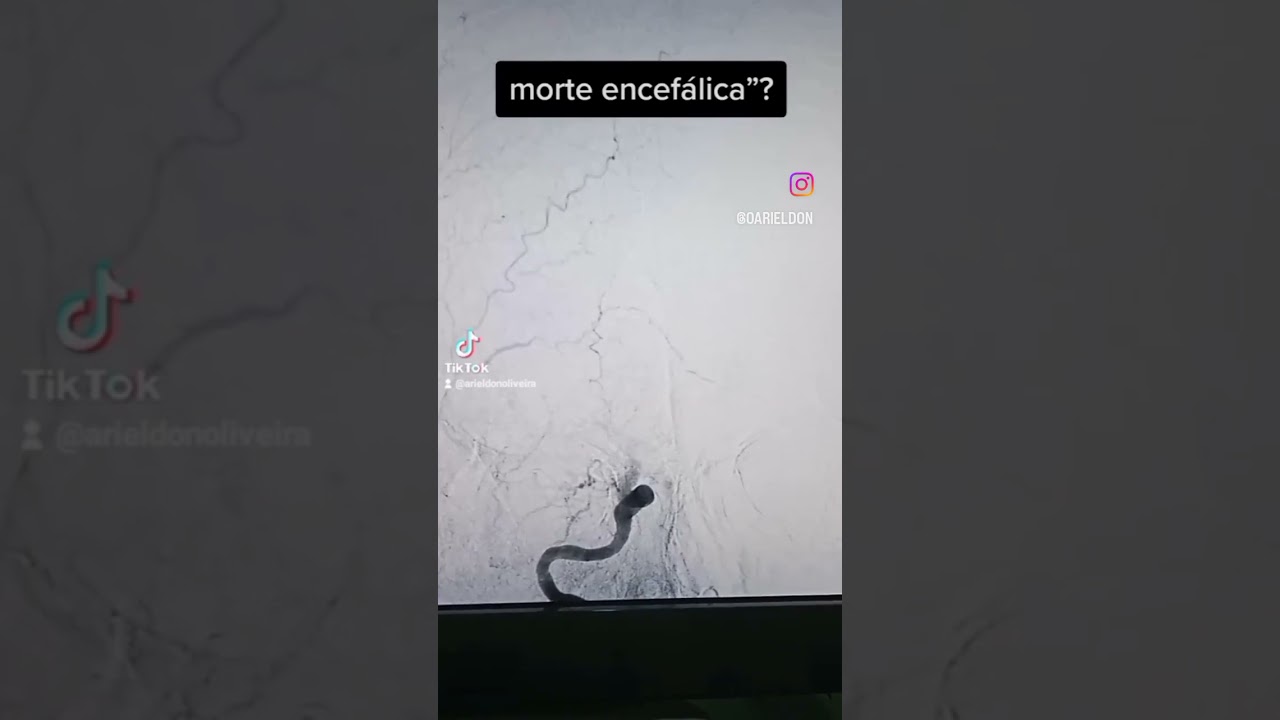 arteriografia cerebral (morte cerebral)