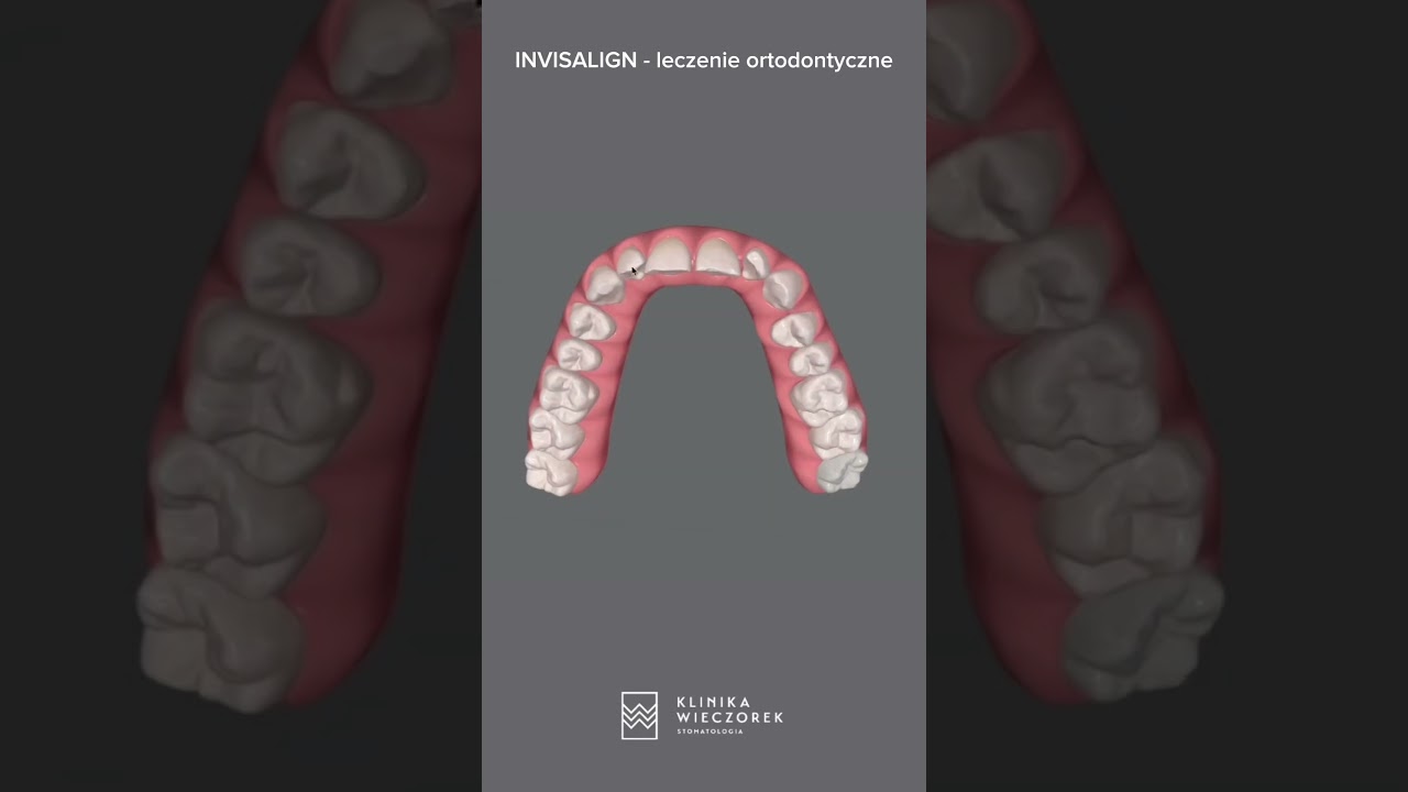 JAK DZIAŁA INVISALIGN? | Klinika Wieczorek