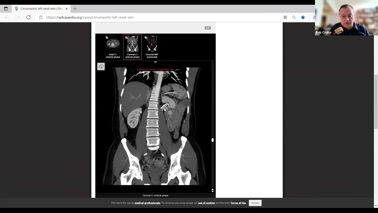Vascular Anomalies: IVC