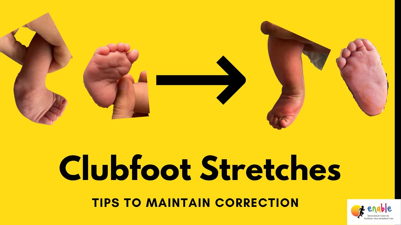 How to do Clubfoot Stretches- Parent information to avoid relapses. Post Ponseti exercises.  #shorts