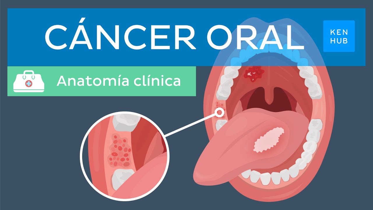 Cáncer oral: Definición, factores de riesgo, prevención, diagnóstico y tratamiento | Kenhub
