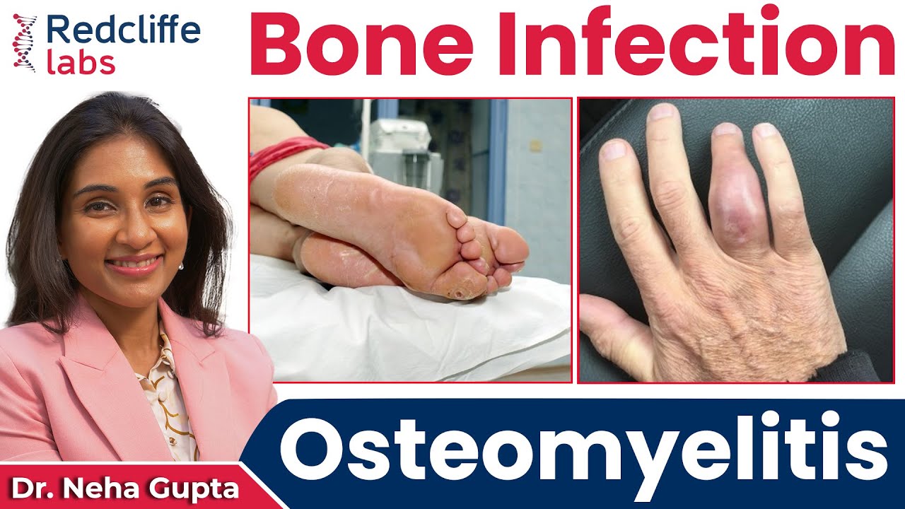 💹 What is Osteomyelitis? Osteomyelitis (Bone Infection) Symptoms, Causes And Treatment | Redcliffe