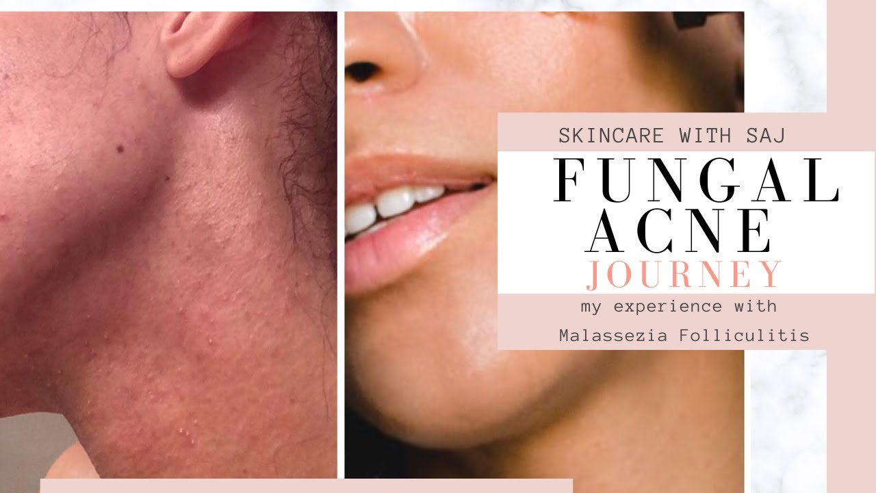My Fungal Acne Nightmare!  | Fungal Acne journey and How I got rid of it | Skincare with SAJ