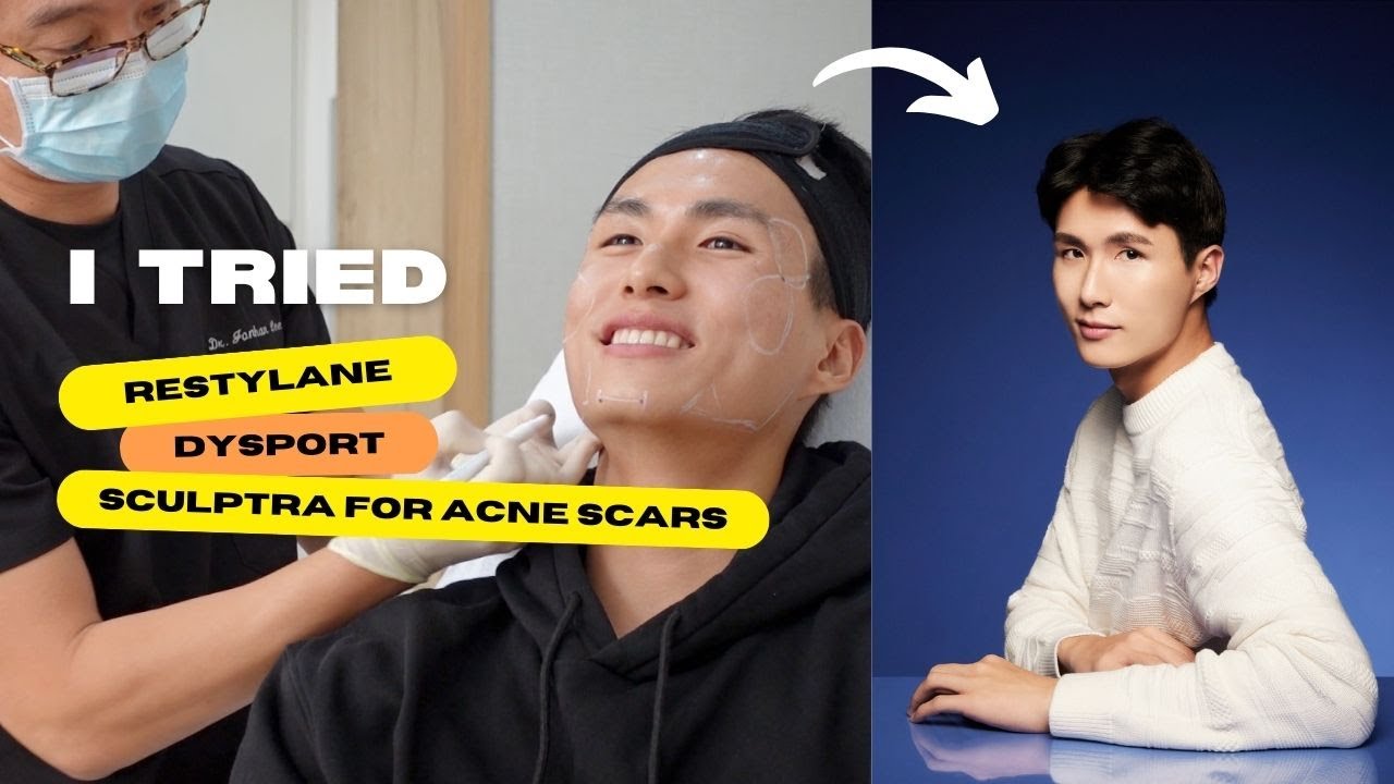 2023 ACNE SCAR UPDATE | non-invasive “plastic surgery”? Before & After 💉
