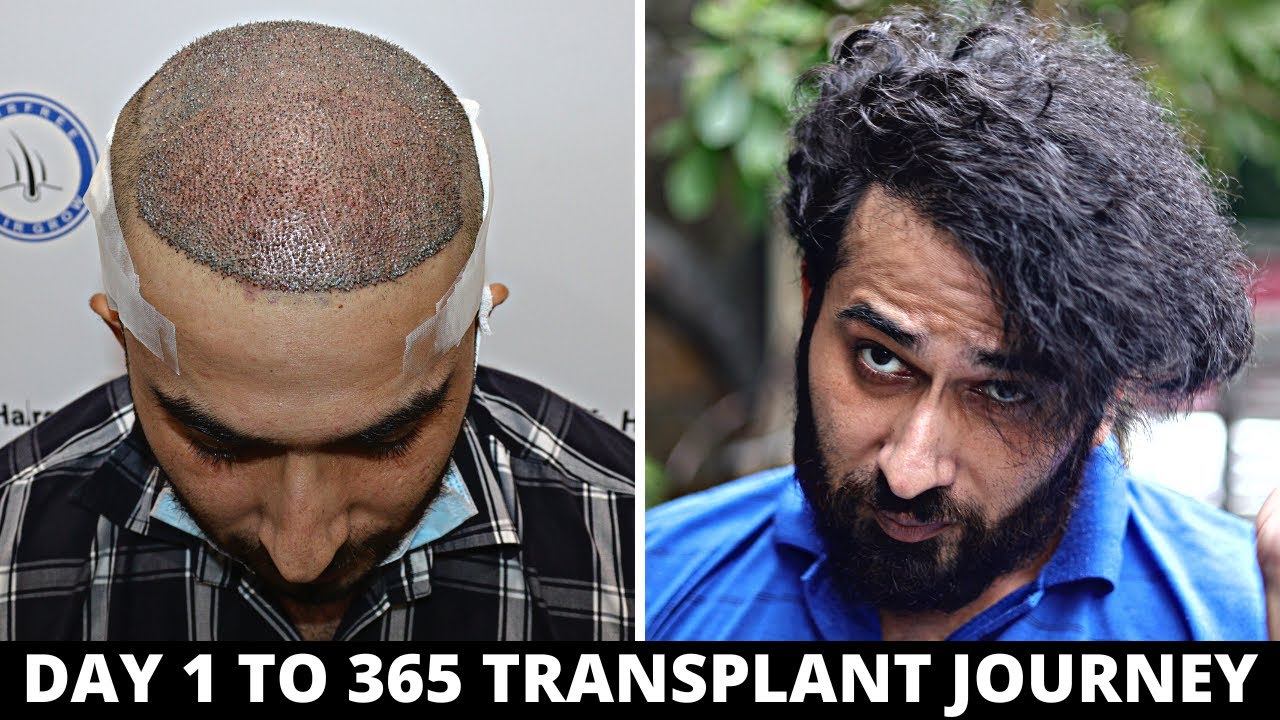 hair transplant 365 days journey | Born Creator transplant journey