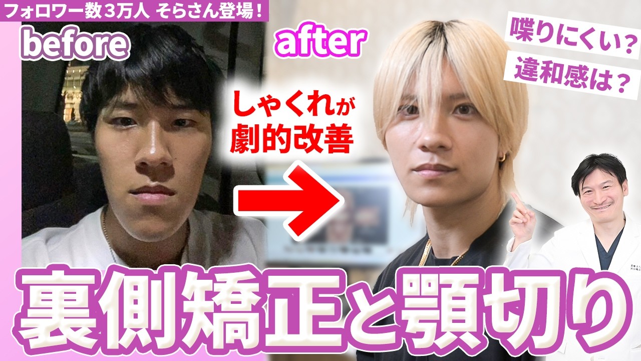 反対咬合を顎切り＋歯列矯正で治療中のフォロワー数3万人の そらさんの症例を解説しました！