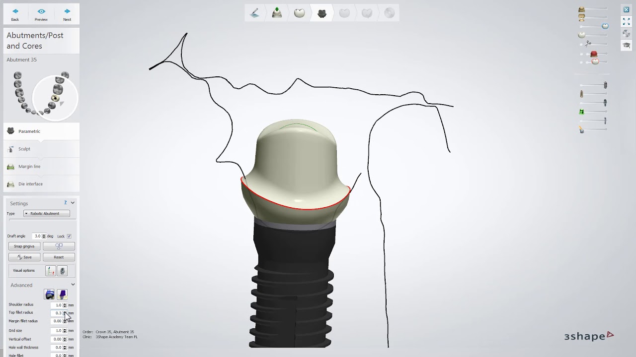 3Shape 덴탈시스템 - 어버트먼트 및 크라운 디자인 - 3Shape Dental System - Abutment and Crown Design