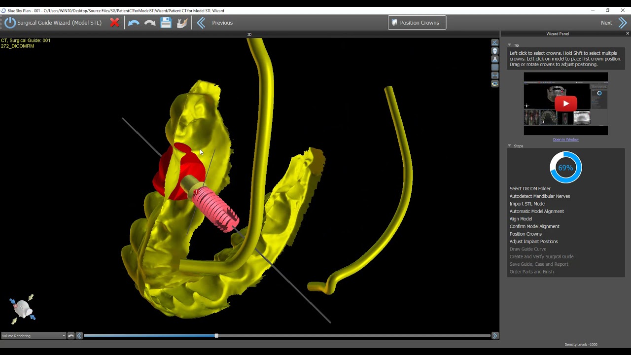 BSP4.9 - Step by Step Implant Planning Wizard