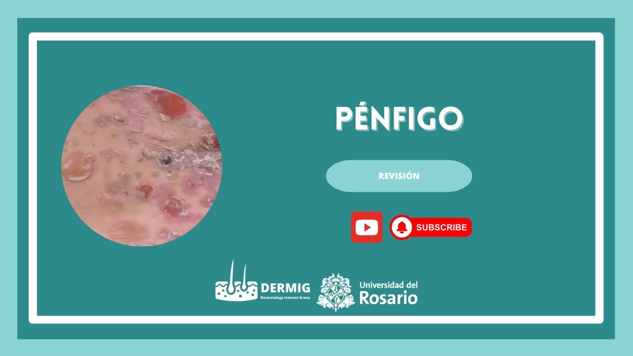 Pénfigo