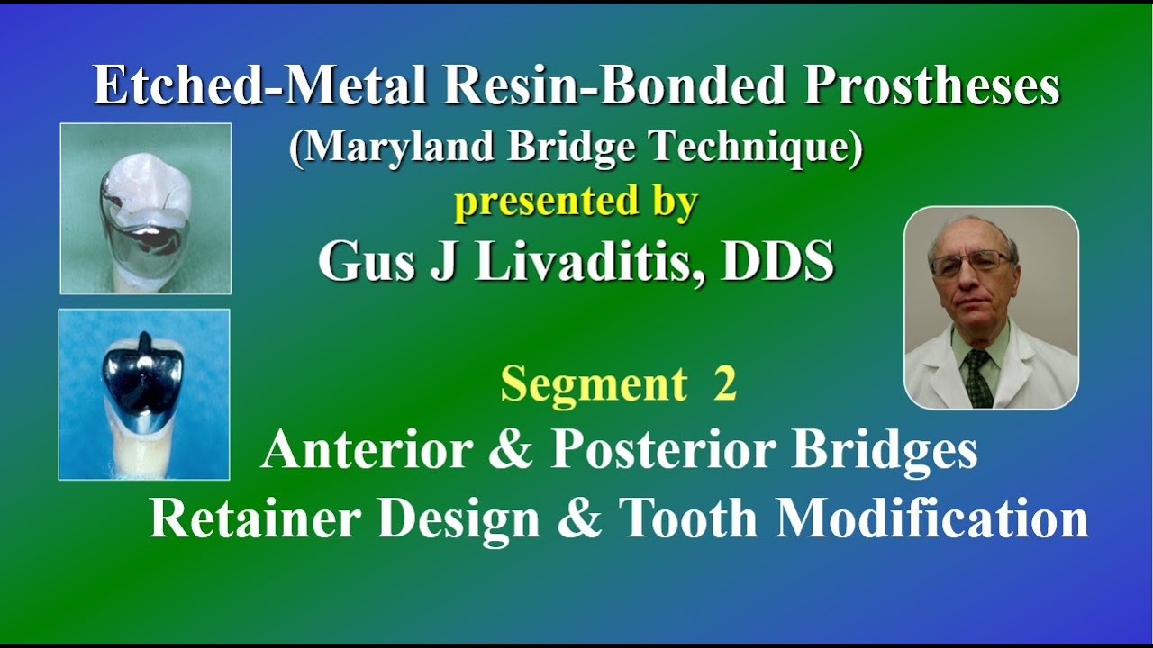 Maryland Bridge Technique: Anterior & Posterior Bridges
