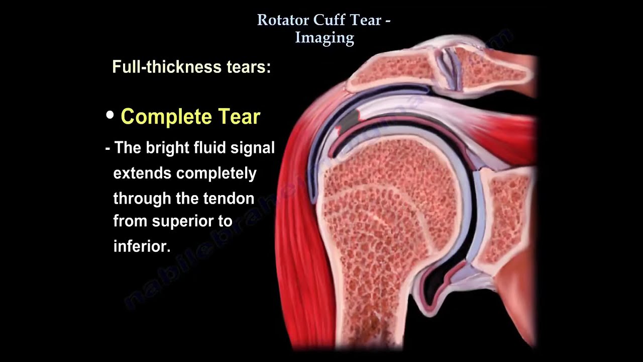 Rotator Cuff tear  Imaging