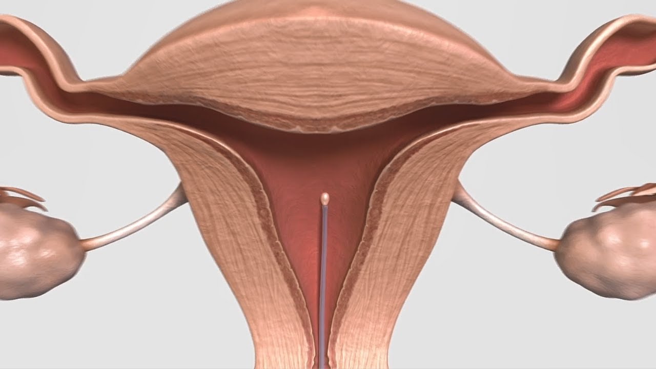 Inseminación intrauterina: Paso a paso