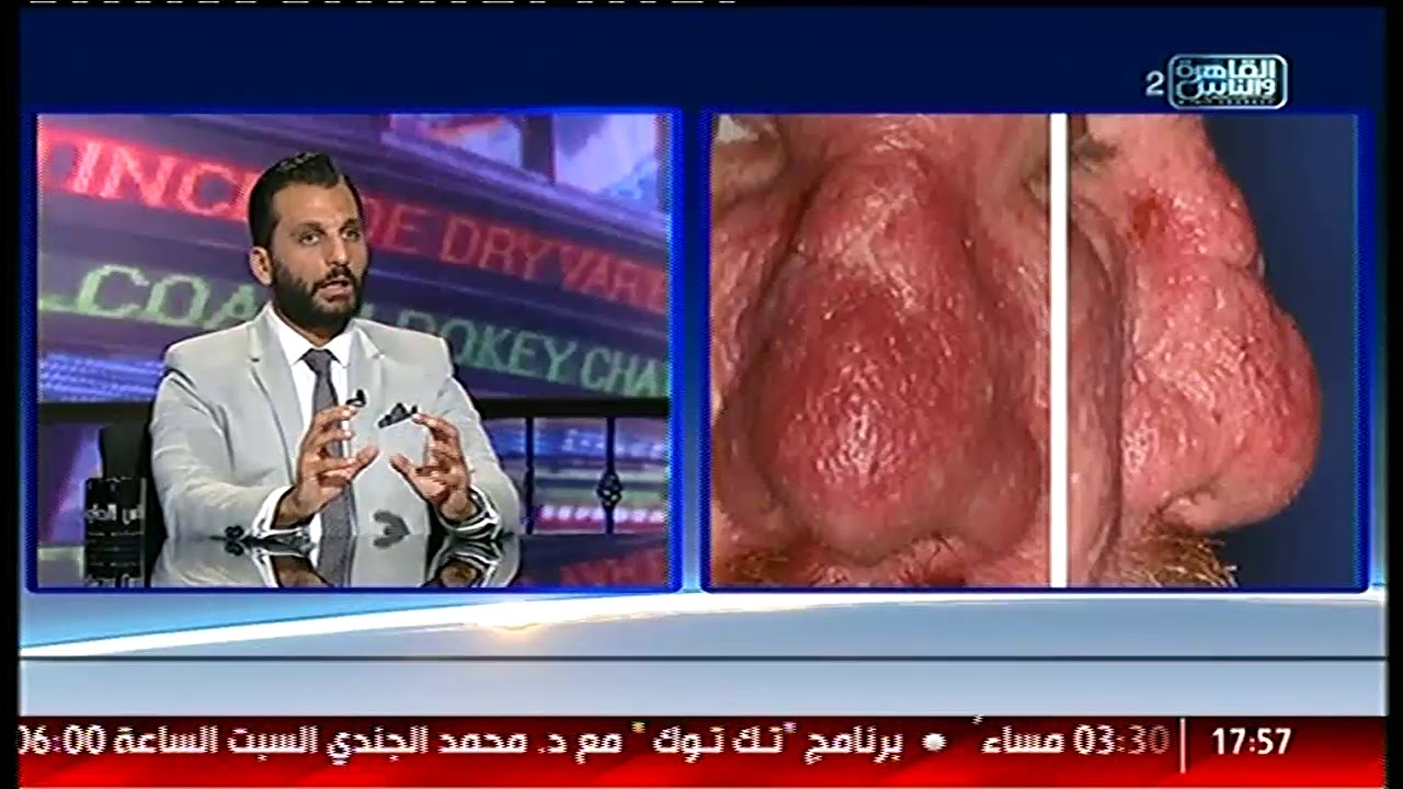 الناس الحلوة | اسباب مرض الوردية وطرق العلاج مع دكتور يحيى حشيش