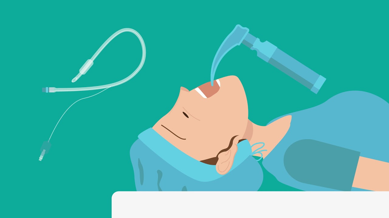 Algehele anesthesie (algehele narcose)