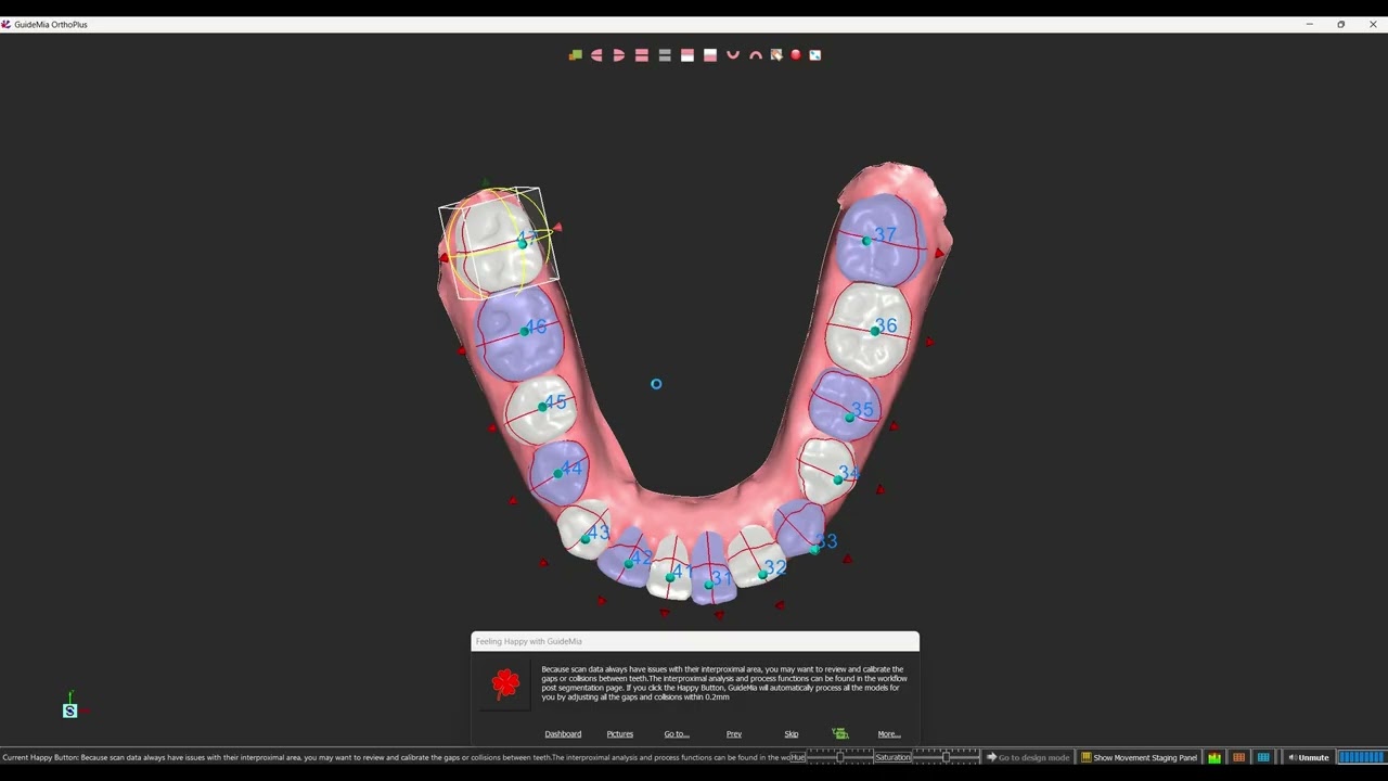 GuideMia OrthoPlus AlignerBot with Brackets