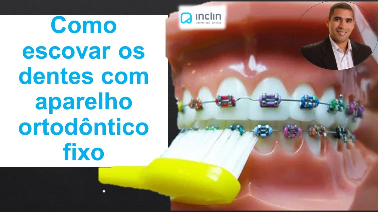 Como escovar os dentes com aparelho ortodôntico fixo. @dr.alexguedes