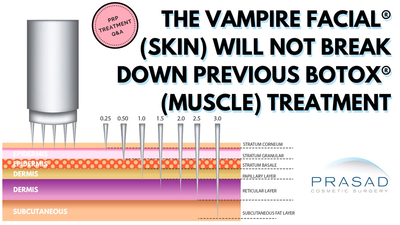 The Vampire Facial (Skin Layers) will not Breakdown Botox Treatment at Deeper Muscle Layer