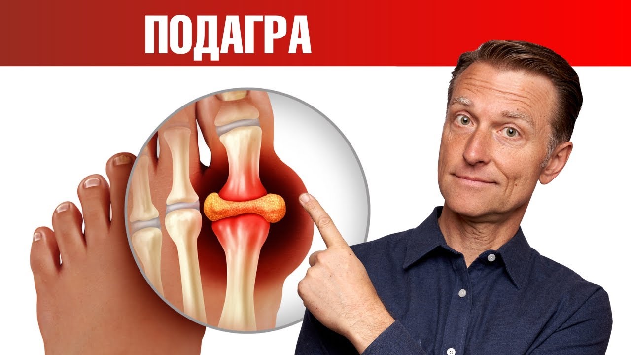 Натуральное и очень действенное средство от подагры 👍